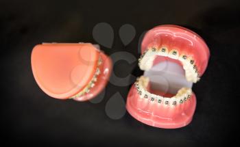 Orthodontic, denture closeup, black background. Dentist cabinet, stomatology. Tooth care mouth hygiene dental medicine