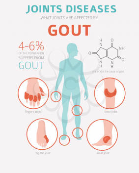 Joints diseases. Gout symptoms, treatment icon set. Medical infographic design. Vector illustration