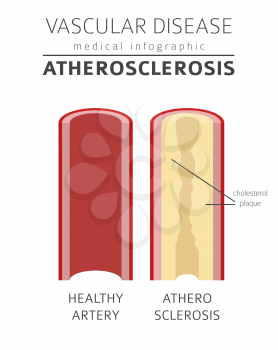 Vascular diseases. Atherosclerosis symptoms, treatment icon set. Medical infographic design. Vector illustration