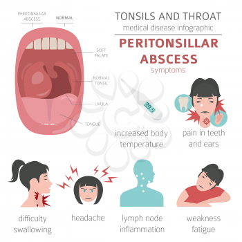 Tonsils and throat diseases. Peritonsillar abscess symptoms, treatment icon set. Medical infographic design. Vector illustration