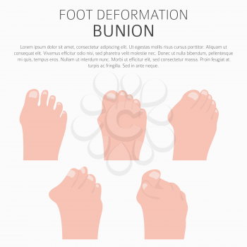 Foot deformation as medical desease infographic. Causes of bunion. Vector illustration