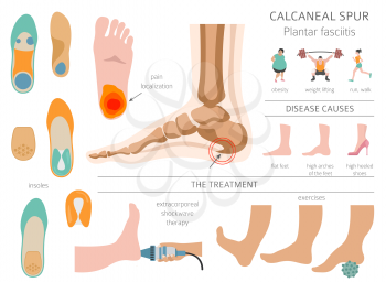 Calcaneal spur. Plantar fasciitis set. Medical desease infographics collection. Vector illustration