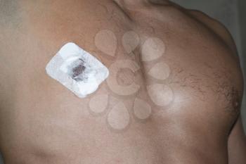 Bactericidal adhesive tape on the male nipple. Dressing after surgery on the nipple areola.