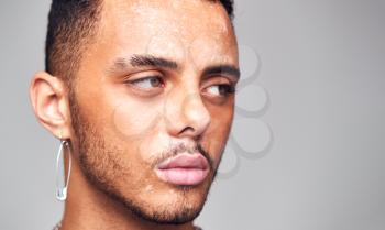 Thoughtful Young Man With Skin Pigmentation Disorder Looking Off Camera In Studio