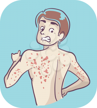 Illustration of a Teenage Boy Looking at His Back and Finding Red Rashes Including His Arms