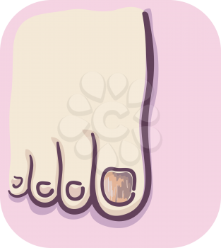 Illustration of Discoloration of Nails in the Foot