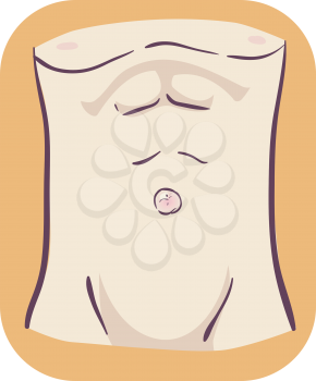Illustration of Umbilical Hernia