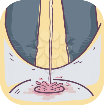 Illustration of a Urinating Man with Pink or Pinkish Urine