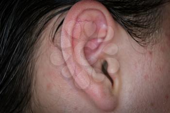 Closeup image of the teen boy ear with skin area about - pimples are all about.