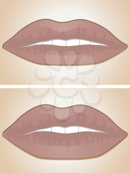 Two sets of lips shown before and after lip filler injections