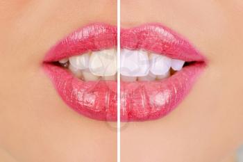 woman teeth before and after whitening