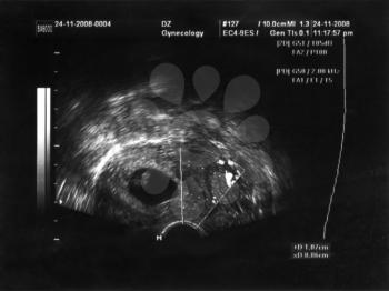 ultrasound portrait of the fetus