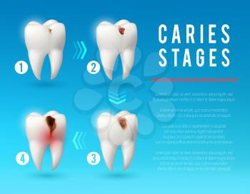 Tooth decay 3d vector poster. Teeth on different stages of dental caries development. Enamel and dentin decay, pulp decay and pulp infection banner for dentist office, dentistry clinic design