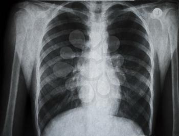 Royalty Free Photo of a Chest X-ray