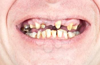 Royalty Free Photo of a Person Smiling With Missing, Broken, and Rotten Teeth