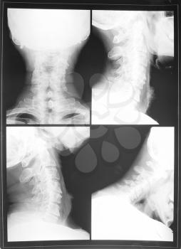 X-ray of the cervical