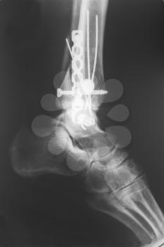 X-ray of the broken leg