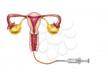 Royalty Free Clipart Image of Artificial Insemination