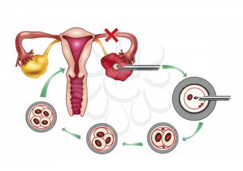Royalty Free Clipart Image of a Diagram of the Process of Artificial Insemination