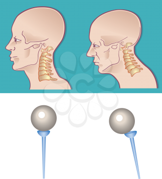 Royalty Free Clipart Image of a Cross Section of a Neck and Spine