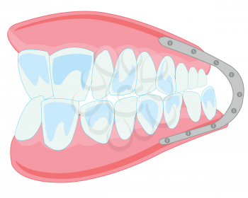 Vector illustration of the denture on white background is insulated