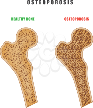 Color drawing of human thigh bone with osteoporosis problem on white background. Two bones are normal and sore. Vector illustration of the medical problem of osteoporosis disease