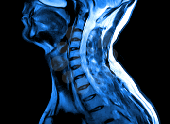Magnetic resonance imaging of the cervical spine. MRI vertebral discs in different views