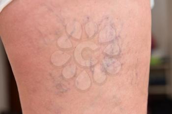 Varicose veins on female legs in the hips.