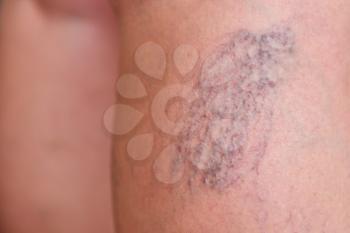 Varicose veins on female legs in the area of the knee and calves. Close-up