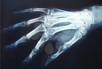 Medical X-Ray imaging of hand fingers used in diagnostic radiology of skeleton bones