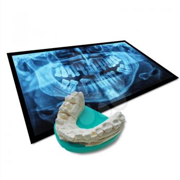 Medical X ray imaging of human teeth with positive dental mould reproduction cast formed from a negative dental impression of teeth isolated over white with soft shadow