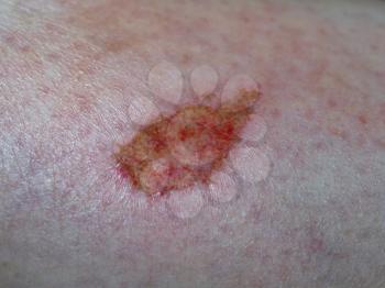 scar tissue following abrasion graze on human limb skin