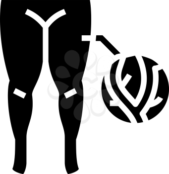 lymphatic edema glyph icon vector. lymphatic edema sign. isolated contour symbol black illustration