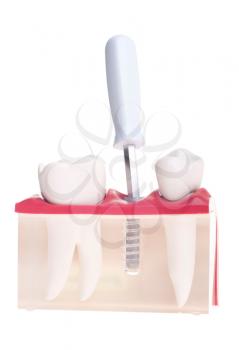 Royalty Free Photo of a Dental Model With Different Types of Treatments