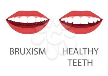 vector illustration of bruxism. grinding of teeth. tooth appliance. dental care. dentistry health problem