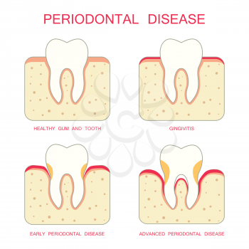 tooth periodontal disease, dental gum  periodontists