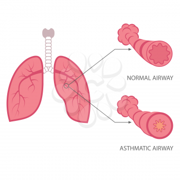 vector asthma illustration, bronchial, lungs respiratory disease