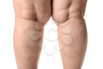 Woman's legs with varicose on white background�