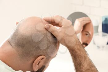 Man with hair loss problem looking in mirror�