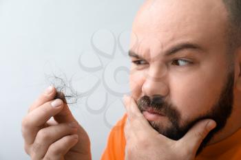 Man with hair loss problem on light background�