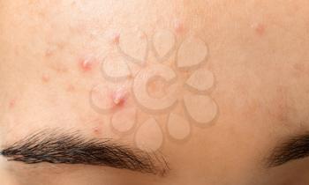Young woman with acne problem, closeup�