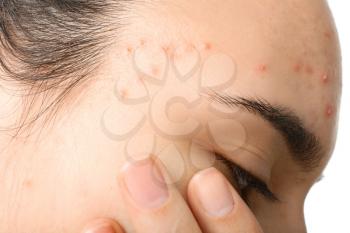 Girl with acne problem, closeup�