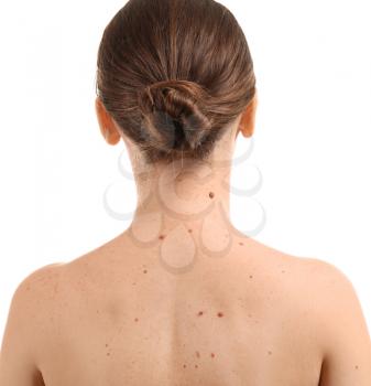 Young woman with moles on white background�