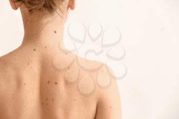 Young woman with moles on white background�