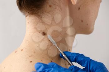 Doctor with lancet going to remove mole from patient's skin, closeup�
