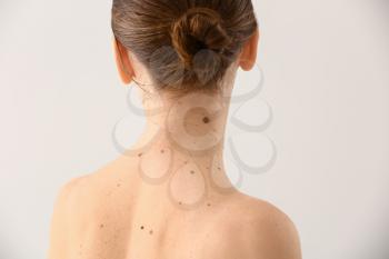 Young woman with moles on light background�