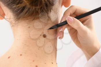 Dermatologist applying marks onto patient's skin before moles removal, closeup�