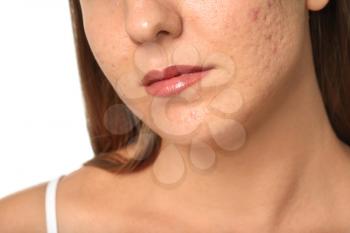 Young woman with acne problem on white background, closeup�