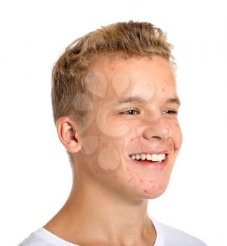 Teenage boy with acne problem on white background�