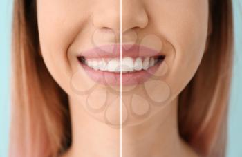Young woman before and after procedure of gingival plasty, closeup�